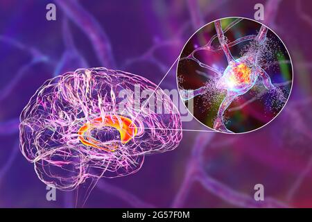 Distruzione di neuroni del nucleo caudato, illustrazione Foto Stock