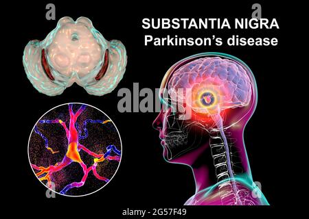 Substia nigra nel morbo di Parkinson, illustrazione Foto Stock