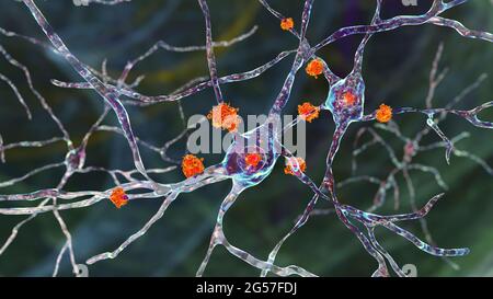 Inclusioni neuronali nella malattia di Huntington, illustrazione Foto Stock