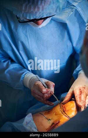 Medico che taglia l'addome del paziente con il bisturi mentre si esegue la chirurgia della pancia del tuck in sala operatoria. Operaio medico che fa chirurgia plastica addominale in clinica. Concetto di procedura di abdominoplastica. Foto Stock