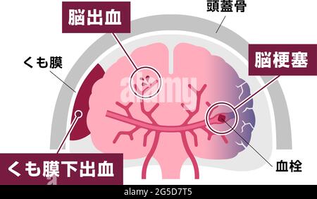 Tipi di illustrazione vettoriale dell'ictus cerebrale umano Illustrazione Vettoriale