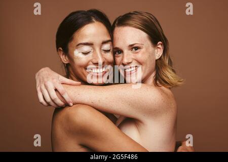 Due giovani donne con bella pelle che si tengono in braccio. Donna con pelle diversa che accetta la loro bellezza naturale. Foto Stock
