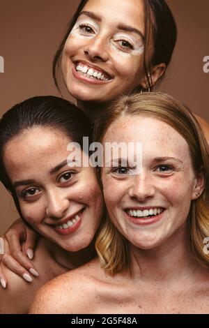 Primo piano ritratto di tre giovani donne sorridenti insieme. Ritratto di donna con problemi di pelle di umore allegro che rappresenta l'accettazione di sé e il corpo p Foto Stock