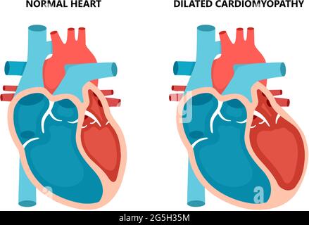 Cardiomiopatia dilatata con vista in sezione trasversale. Malattie del muscolo cardiaco umano. Concetto di cardiologia. Illustrazione Vettoriale