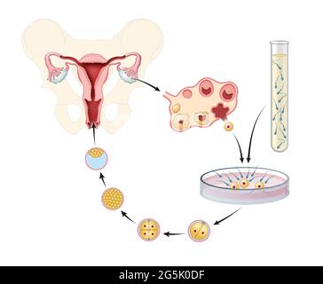 Inseminazione artificiale. Fertilizzazione in vitro. Illustrazione Foto Stock