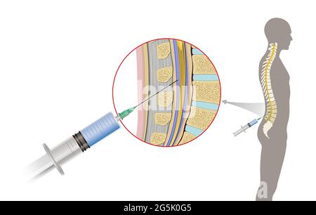 La puntura lombare, nota anche come rubinetto spinale, è una procedura medica in cui un ago è inserito nel canale spinale. Liquido cerebrospinale Foto Stock