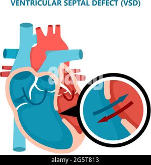 Difetto del setto ventricolare VSD. Malattie del muscolo cardiaco umano sezione trasversale. Concetto di cardiologia. Illustrazione Vettoriale