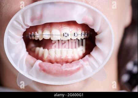 Immagini Stock - Primo Piano Del Paziente Con Il Divaricatore Della Guancia  In Bocca Che Riceve Un Trattamento Dentale. Medico Che Utilizza Strumenti  Dentali Durante La Pulizia Dei Denti Della Giovane Donna.