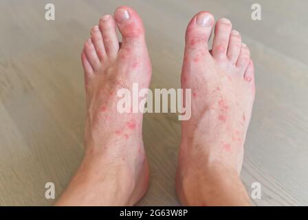 primo piano su molti morsi di zanzara sulla pelle del piede degli uomini. Foto Stock