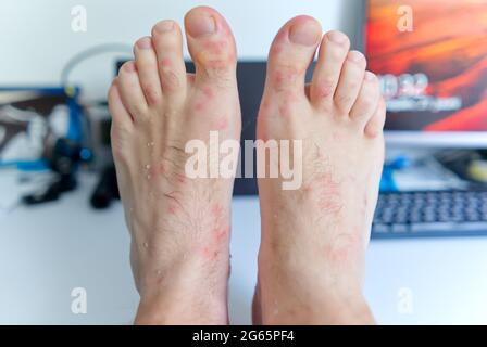 primo piano su molti morsi di zanzara sulla pelle del piede degli uomini. Foto Stock