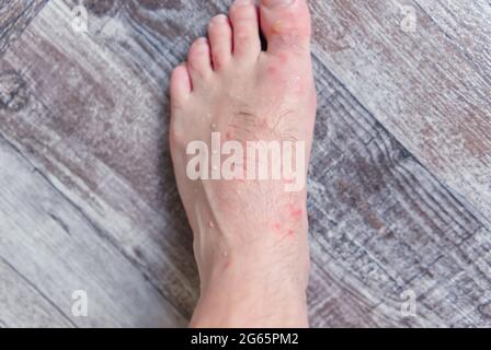 primo piano su molti morsi di zanzara sulla pelle del piede degli uomini. Foto Stock