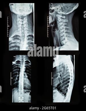 Radiografia di una colonna vertebrale femminile con una scansione rm di scoliosi grave Foto Stock