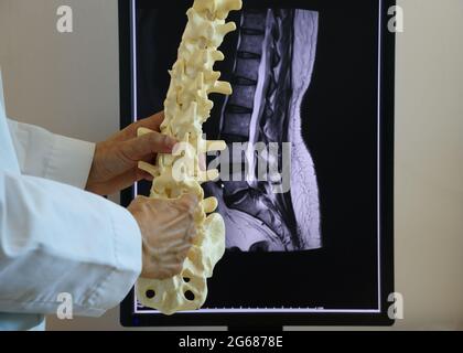 Medico che tiene il modello della colonna lombare davanti allo schermo del computer della colonna vertebrale RM Foto Stock