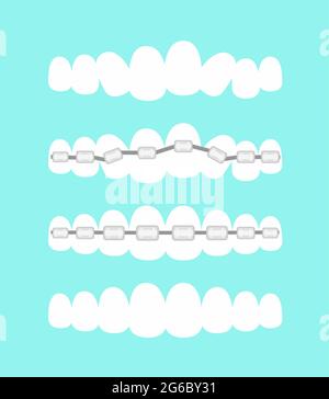 Illustrazione vettoriale insieme di denti, odontoiatria trattamento con denti bretelle, processo di livella denti, bel sorriso in stile piatto cartoon. Illustrazione Vettoriale