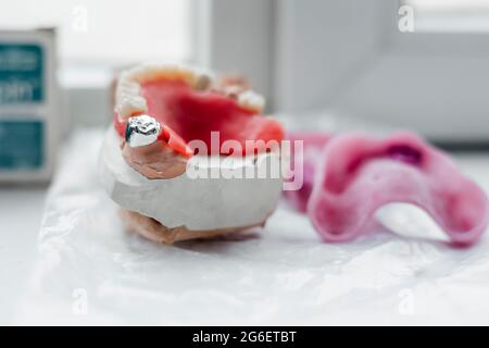 Artificiale di acciaio la corona dentale per la dentizione restauro Foto Stock