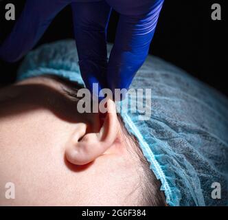 Un chirurgo di plastica esegue un'operazione per correggere le orecchie di una paziente femminile. Otoplastica, eliminazione delle orecchie sporgenti, chirurgia plastica Foto Stock
