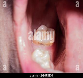 Foro dopo la rimozione di un dente da masticare in bocca. Guarigione delle gengive dopo l'estrazione dei denti in odontoiatria, macro Foto Stock