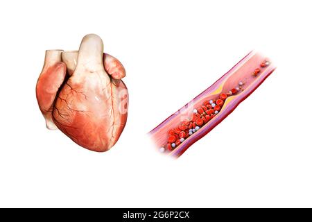 Attacco di cuore, aterosclerosi: La placca di colesterolo si forma in arteria, rotture, le forme di coagulo di sangue e l'arteria bloccata, illustrazione Foto Stock