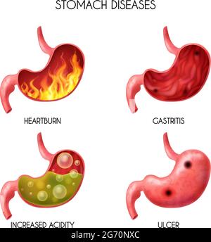 Realistico organo interno umano stomaco icona insieme pirosi fuoco disturbo gastrico acido reflusso addominale gonfiore palla nausea vettore illustrazione Illustrazione Vettoriale