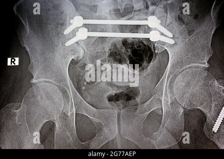 Radiografia piana con una pelvi da frattura fissata con 4 viti e 2 aste e frattura di un grande trocantere del femore fissato con 2 viti Foto Stock