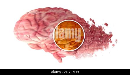 La memoria decade, dimentica le cose, malattia degenerativa. Problemi cerebrali. Morbo di Parkinson e malattia di alzheimer. Salute mentale. Ictus, sinapsi e neuroni Foto Stock