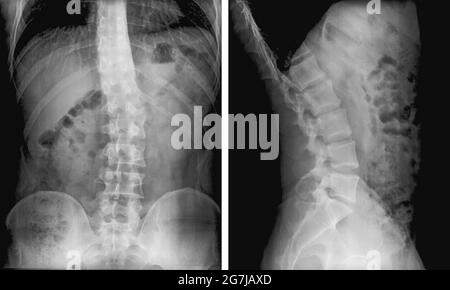 Pellicola radiogena di curvatura spinale (Scoliosi). Grave scoliosi medica. Diagnosi del paziente con scansione radiografica con sistema di guida. Diagnostica dorsale e congiunta Foto Stock