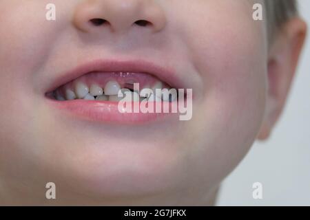 Sorridente bocca del ragazzo senza dente anteriore Foto Stock