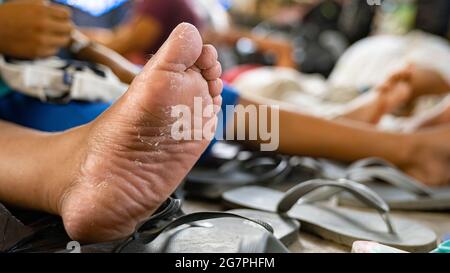 Reynosa, Messico. 15 luglio 2021. I piedi di womanÕs mostrano delle bolle difettose causate dal lungo viaggio dal Guatemala al confine tra Messico e Stati Uniti. Credit: Lexie Harrison-Cripps/Alamy Live News Foto Stock