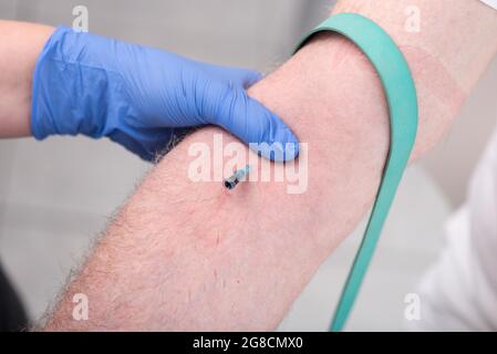 Catetere posizionato nella vena di un paziente Foto Stock