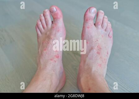 primo piano su molti morsi di zanzara sulla pelle del piede degli uomini. Foto Stock