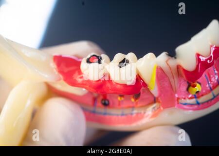 Dentisti di decadimento dentistico modello dentale di denti, gengive e canale radicolare Foto Stock