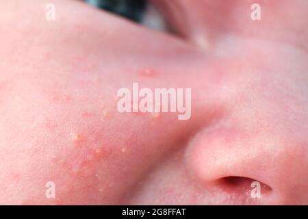 Acne sulla faccia di un bambino neonato, primo piano. Macro foto di difetti della pelle nel bambino Foto Stock