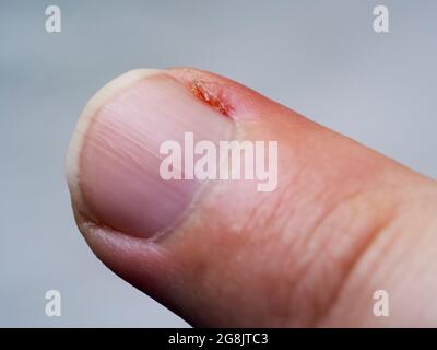 Cuticola infiammata sul dito. Parte danneggiata del dito, primo piano. Foto Stock