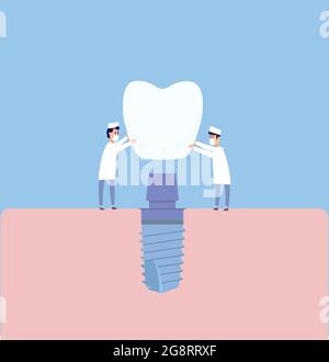 Due dentisti eseguono l'impianto dentale: Installare l'impianto sull'abutment. Illustrazione vettoriale, in stile piatto. Poster alla clinica, immagine per le istruzioni per i dentisti, libri di formazione Illustrazione Vettoriale