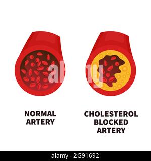 Iperlipidemia, illustrazione concettuale Foto Stock