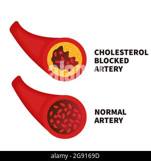 Iperlipidemia, illustrazione concettuale Foto Stock