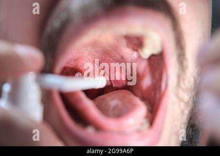 Primo piano di un uomo bocca con uno spray per trattare un afte o un mal di gola. Foto Stock