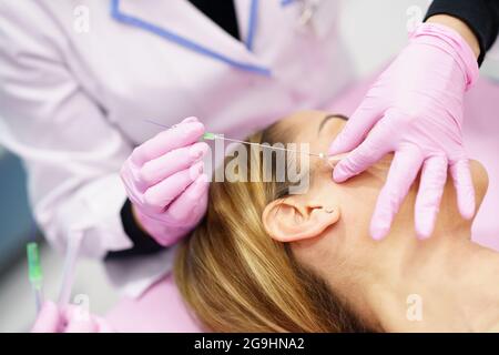 Medico iniettando i fili di trattamento di sutura di PDO nella faccia di una donna. Foto Stock