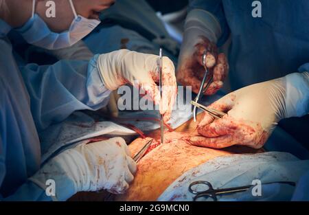 Primo piano di medico e assistente in guanti che mettono suture dopo la chirurgia di Tummy Tuck in ospedale. Operatori medici che eseguono chirurgia plastica addominale. Foto Stock