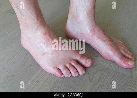 primo piano su molti morsi di zanzara sulla pelle del piede degli uomini. Foto Stock