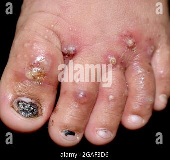 Infestazione di scabbia con infezione batterica secondaria o sovrapposta e pustole ai piedi del sud-est asiatico, bambino birmano. Una pelle contagiosa Foto Stock