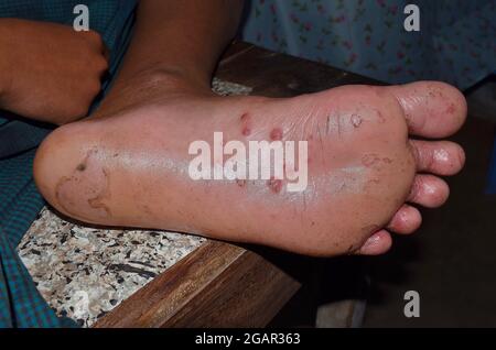 Infestazione di scabbia con infezione secondaria o fungina o pedis di tinea ai piedi dell'uomo del Sudest asiatico. Isolato su sfondo nero Foto Stock