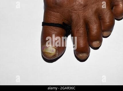 Paronichia acuta e laccio emostatico all'alluce dell'uomo del Sud-est asiatico. Vista dall'alto. Foto Stock