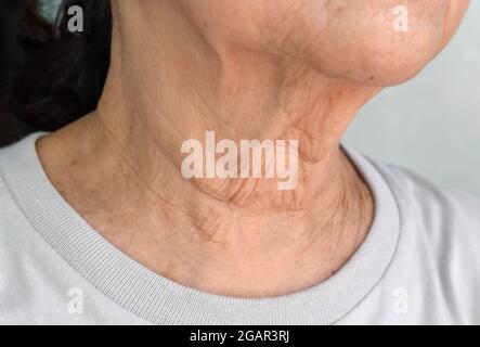 Pieghe della pelle o pieghe della pelle o rughe al collo del Sudest asiatico, donna anziana cinese. Foto Stock