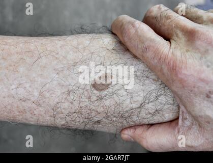 Punto di età o nevo sulla gamba con la pelle pelosa dell'uomo anziano asiatico. Sono macchie marroni, grigie o nere e chiamati macchie di fegato, lentigo senile, lentig solare Foto Stock