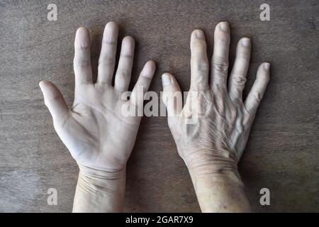 Palmo palmo e superficie dorsale pallida di entrambe le mani. Mani anemiche della donna asiatica, cinese. Isolato su sfondo di legno. Foto Stock