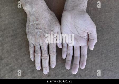 Palmo palmo e superficie dorsale pallida di entrambe le mani. Mani anemiche dell'uomo asiatico, cinese. Isolato su sfondo di legno. Foto Stock