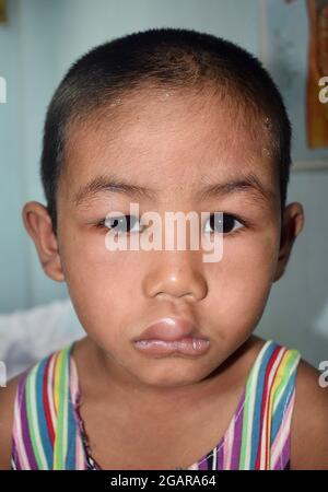 Angioedema alle palpebre e alle labbra del bambino del Sudest asiatico. Viso gonfio. Bambino edematoso. Causato da nefrite, sindrome nefrosica, droga, frutti di mare o c Foto Stock