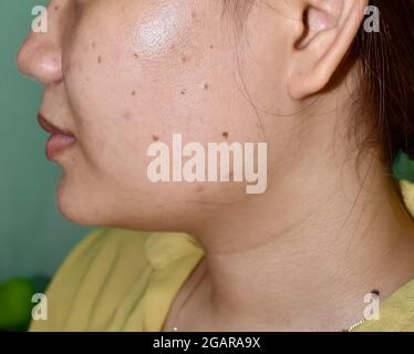Acne vulgaris e macchie nere sopra faccia oleosa della donna del sud-est asiatico. L'acne si verifica quando i follicoli dei capelli diventano tappati con l'olio e le cellule morte. Caus Foto Stock