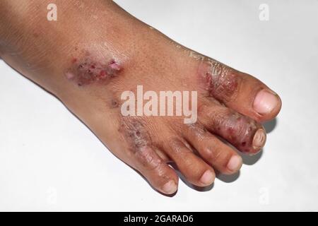 Infestazione di scabbia con infezione batterica secondaria o sovrapposta e pustole ai piedi del sudest asiatico, bambino birmano. Un condimento contagioso della pelle Foto Stock